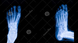 Plantar Fasciitis